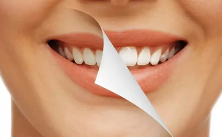 Carillas dentales: qué son, para quién son y qué esperar