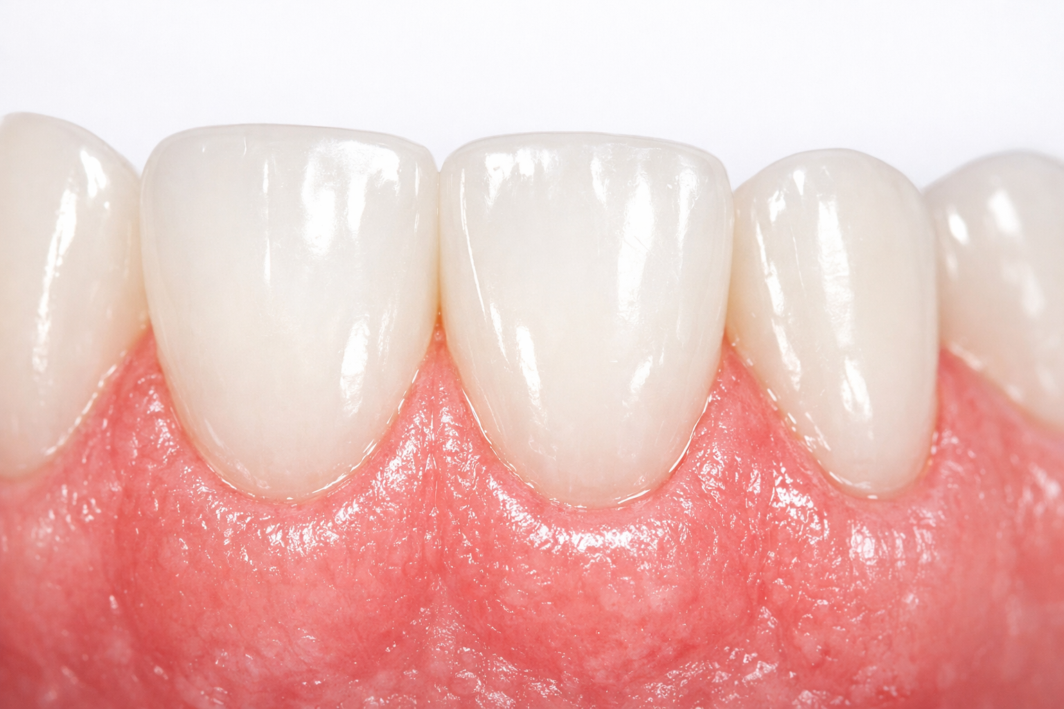 Por qué hay que tener las encías sanas antes de un implante