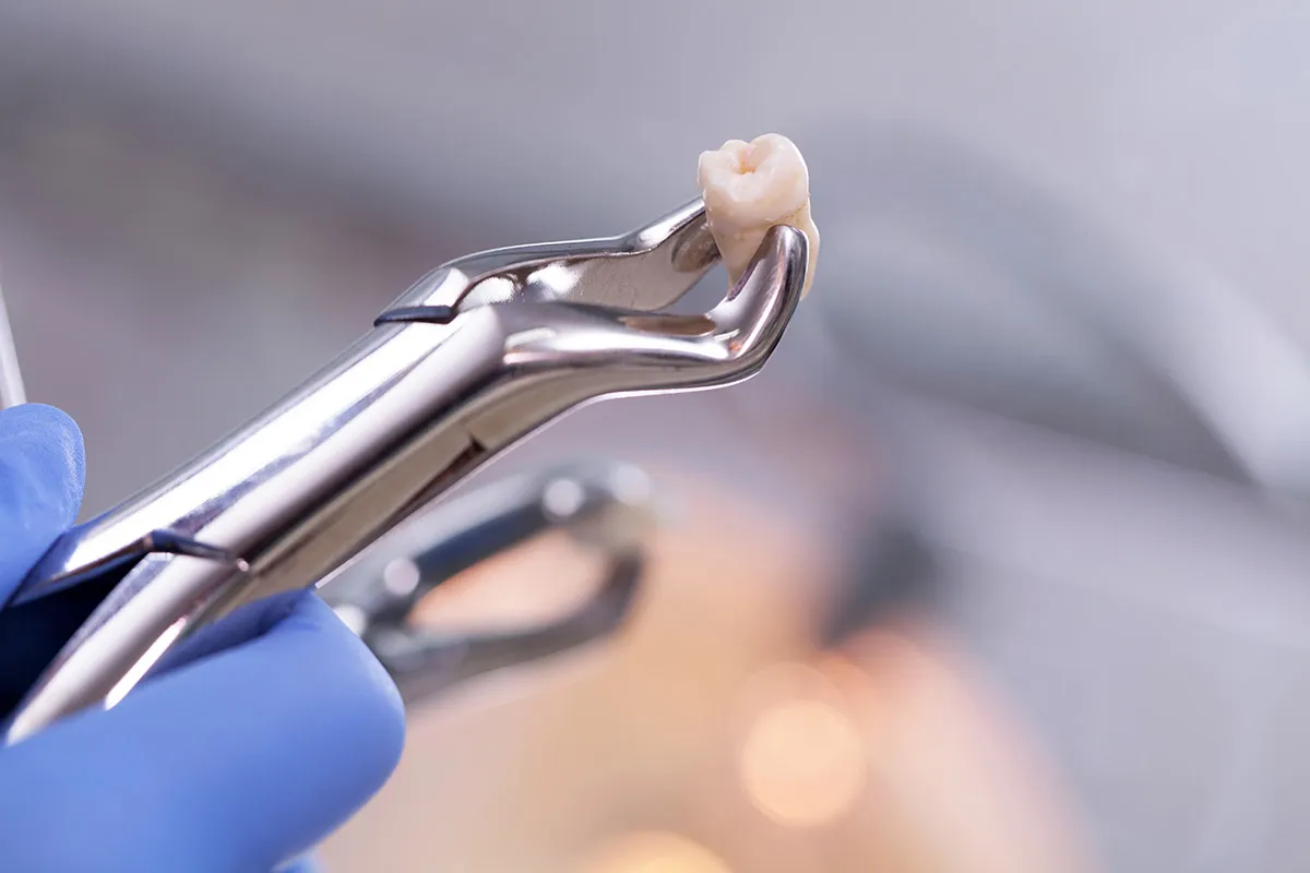 Extracciones dentales: todo lo que necesitas saber