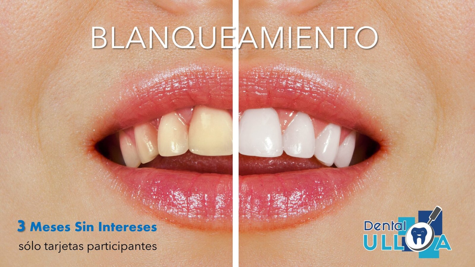 todo sobre el blanqueamiento dental