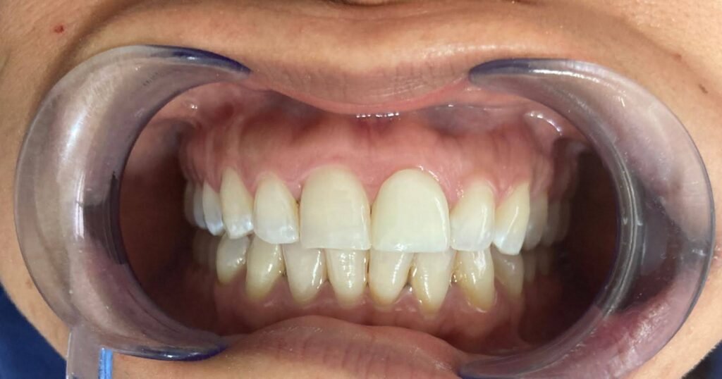 Prostodoncia con Zirconia - Dental Ulloa