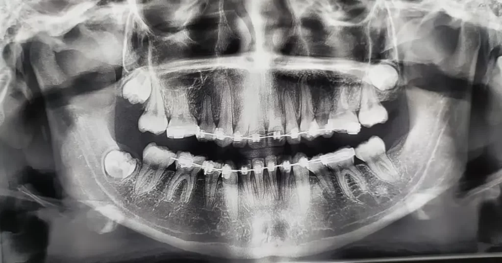 Radiografía paciente con muelas del Juicio.