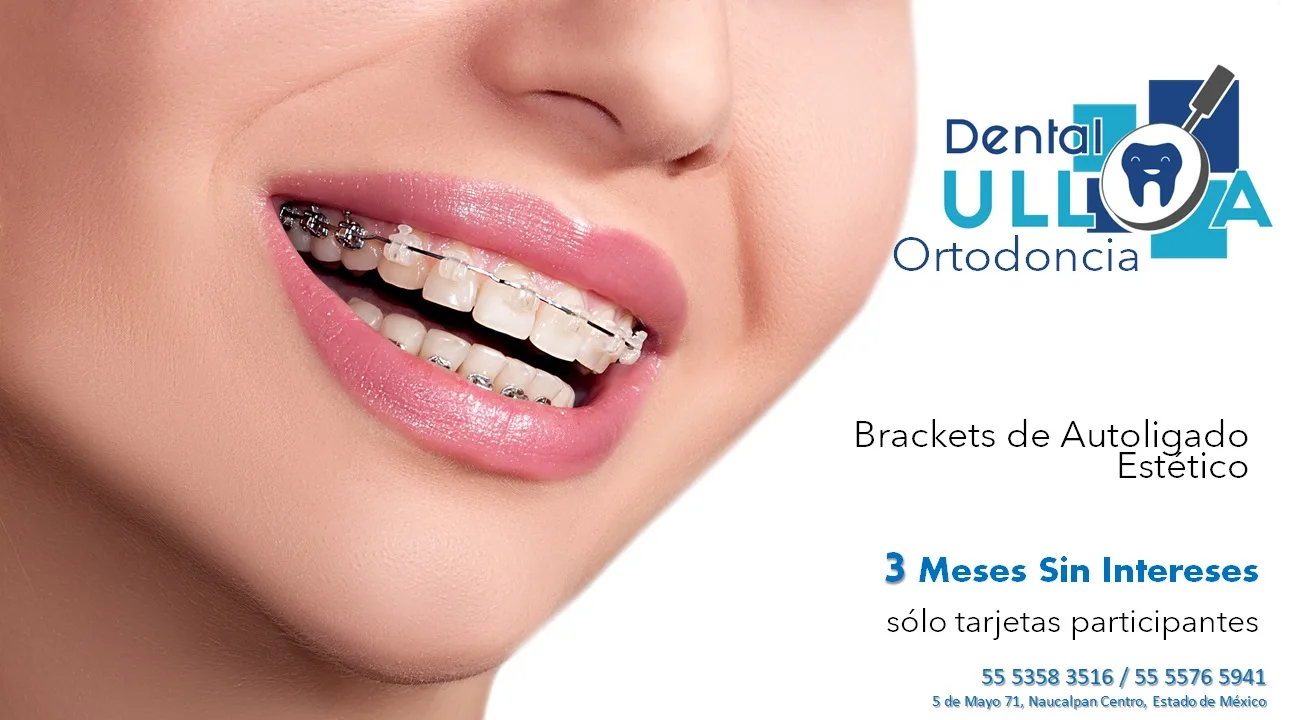 Ortodoncia en Dental Ulloa paga a meses y plazos diferidos