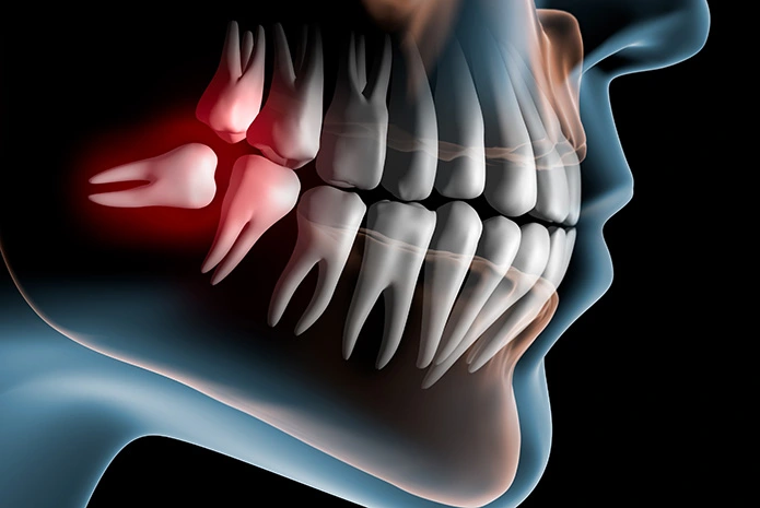 Tercer Molar Impactado