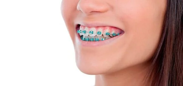 Brackets metálicos tradicionales