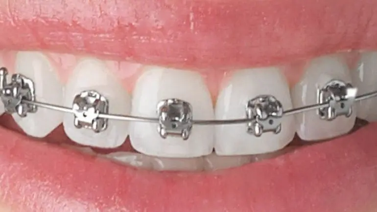 Qué tipos de brackets existen en ortodoncia? Listado de Brackets