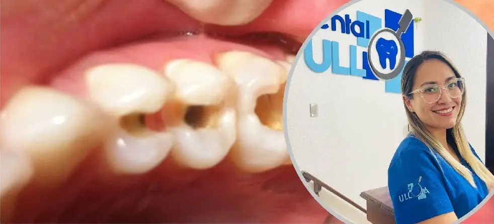 Clínica Dental México: Restaura tu diente lesionado
