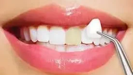 Carillas Dentales: Tipos, Materiales y Recomendaciones