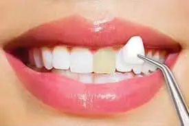 Carillas Dentales