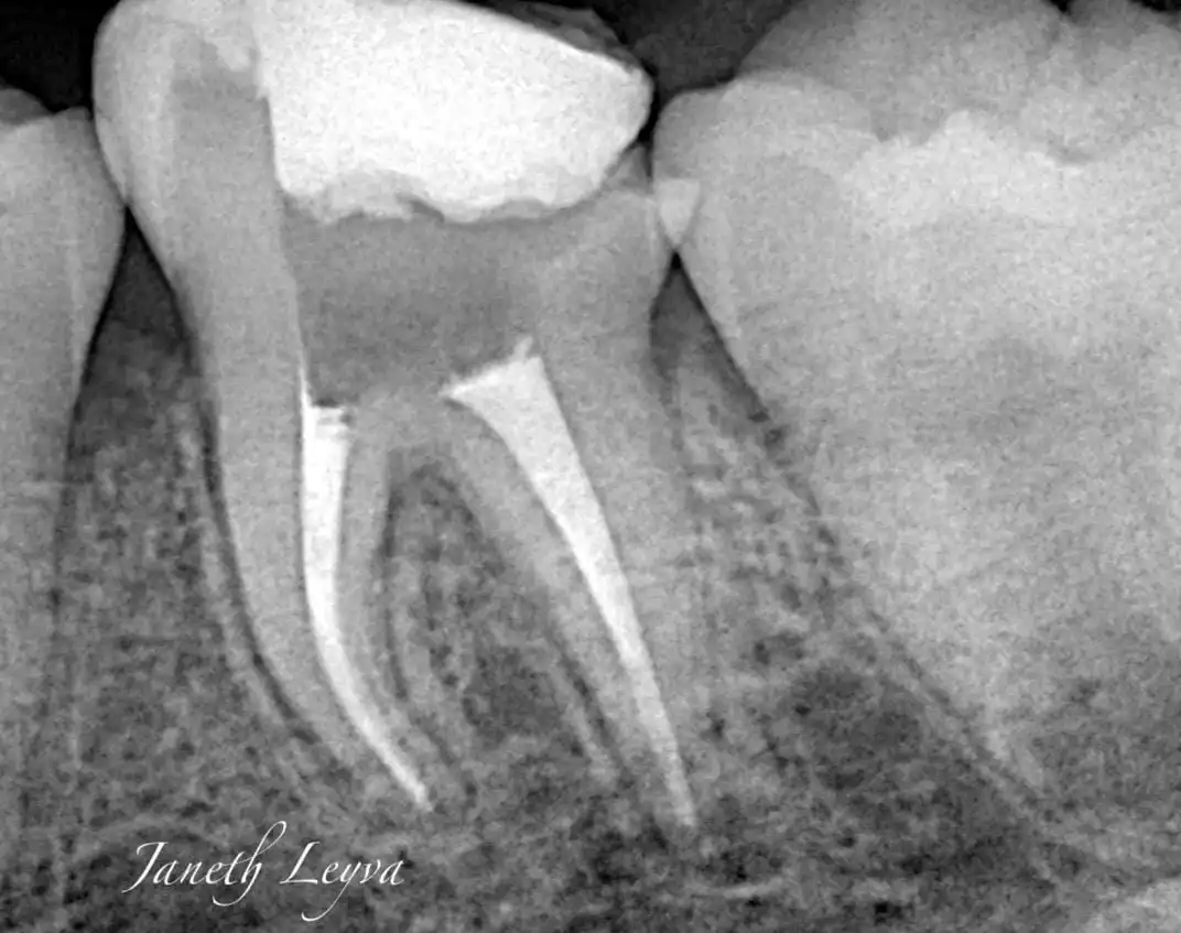¿Qué es la Endodoncia? es uno de los principales tratamientos de la odontología